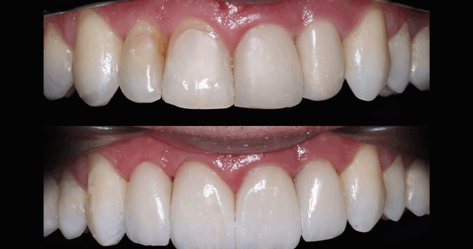 Qual a importância da Periodontia na Odontologia Estética?