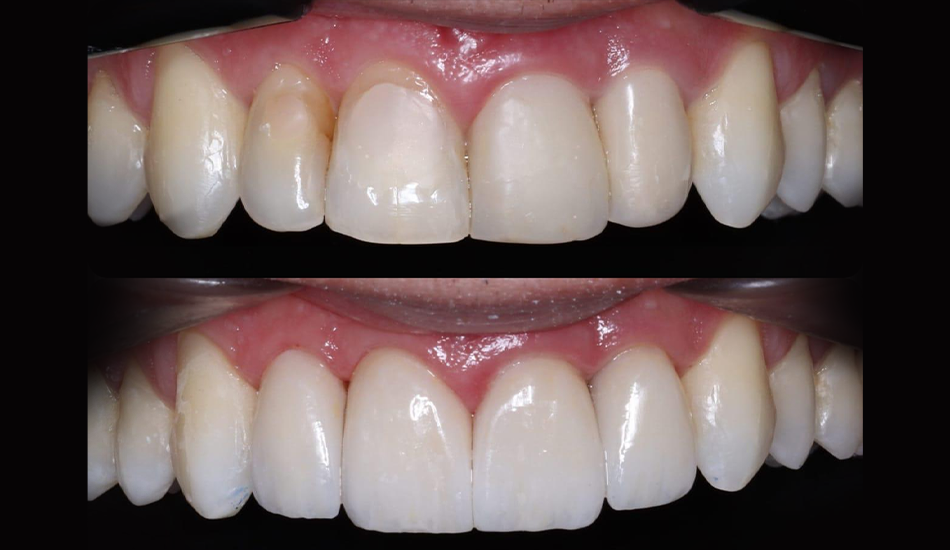 Qual a importância da Periodontia na Odontologia Estética?