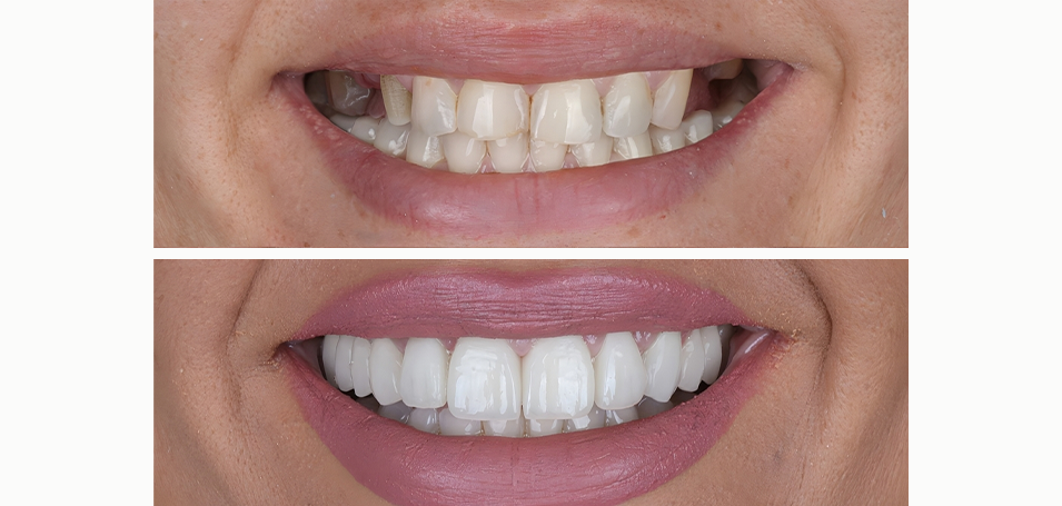 Implantes Dentários: Recupere seu sorriso e qualidade de vida com segurança.