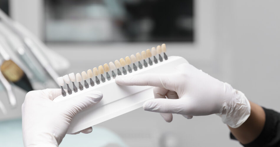 facetas de porcelana