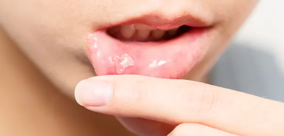 afta na boca