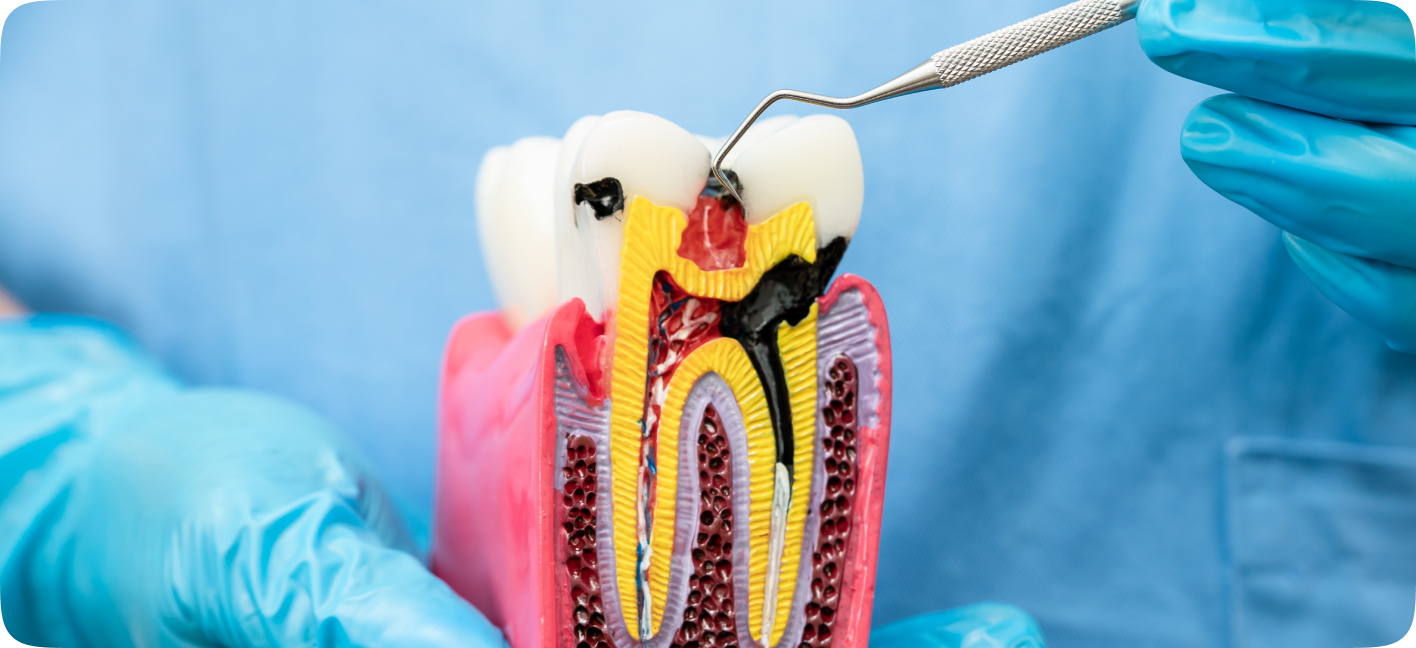 Ilustração de tratamento de canal (endodontia)