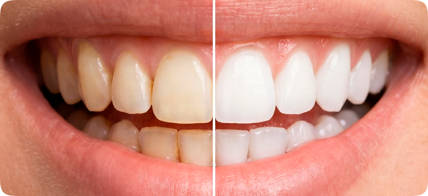 Comparação de dentes antes e depois do clareamento