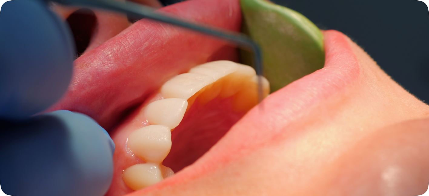 Avaliação da gengiva durante tratamento periodontal