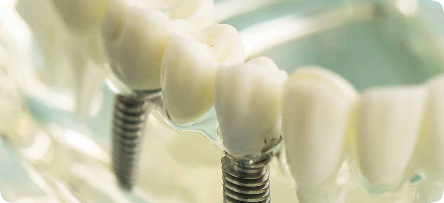 Modelo de implante dentário fixado no osso