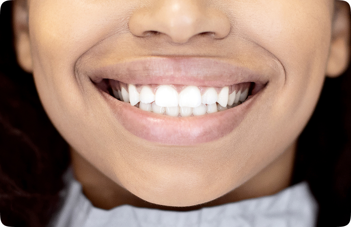 Facetas dentárias