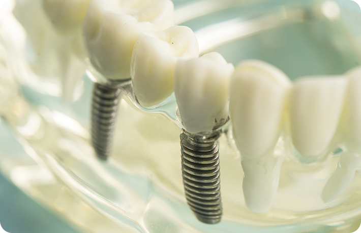 Implantes dentários