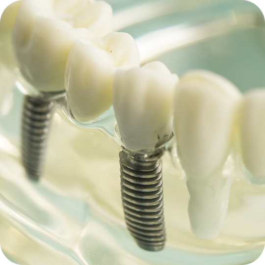 Implantes